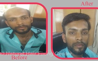 Natural Hair Fixing Center In Falnir Mangalore 575001 Sulekha
