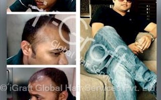 igraft global hair services pvt ltd in defence colony delhi 110033 sulekha delhi igraft global hair services pvt ltd