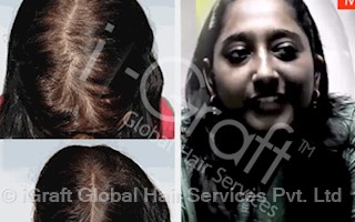 igraft global hair services pvt ltd in defence colony delhi 110033 sulekha delhi igraft global hair services pvt ltd