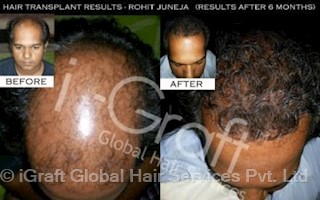 igraft global hair services pvt ltd in defence colony delhi 110033 sulekha delhi igraft global hair services pvt ltd