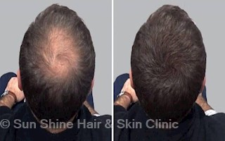 Sun Shine Hair Skin Clinic In Kukatpally Hyderabad 500072 Sulekha Hyderabad