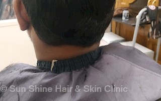 Sun Shine Hair Skin Clinic In Kukatpally Hyderabad 500072 Sulekha Hyderabad