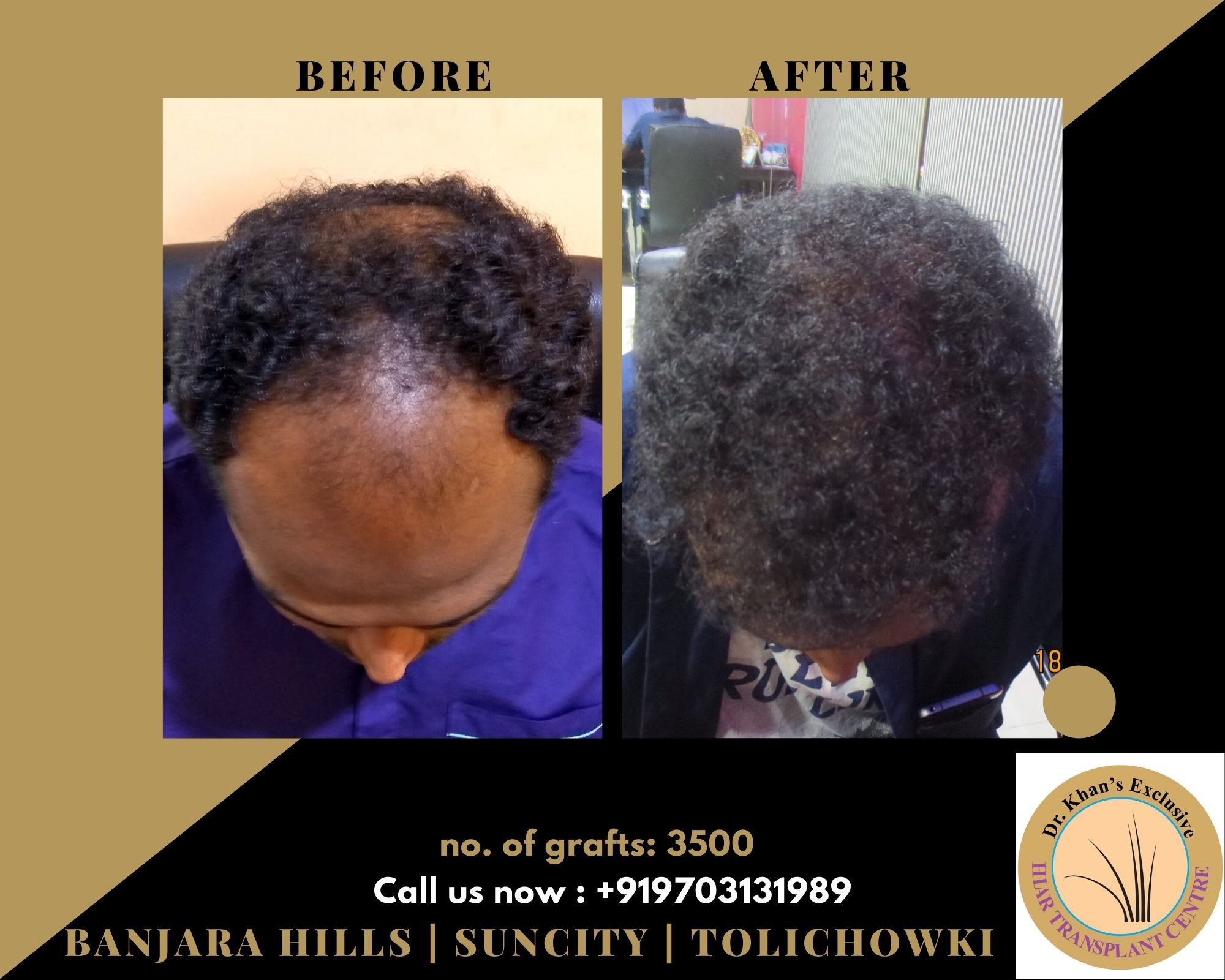 Dr. Khans Exclusive Hair Transplant Center in Banjara Hills, Hyderabad