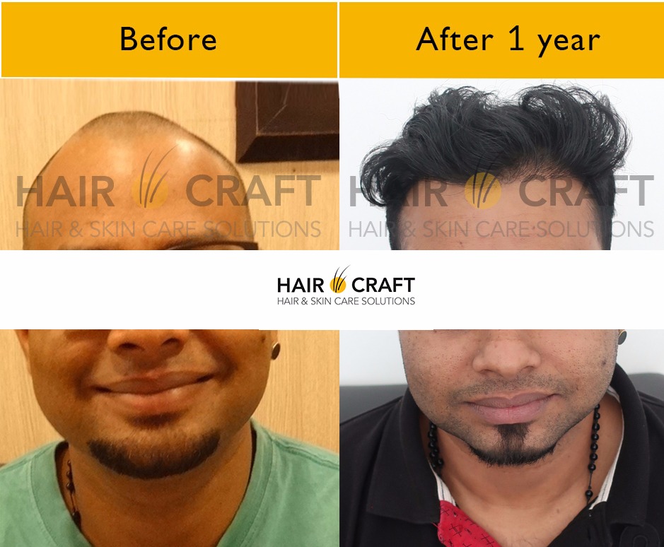 Hair O Craft Hair Transplant Clinic Trivandrum  Hair Transplantation  Clinic in Murinjapalam