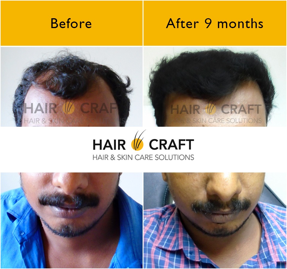 WHY QUALITY OF A HAIR TRANSPLANT CLINIC IS IMPORTANT  Blog  Hair O Craft   Best FUE Hair Transplant Kerala