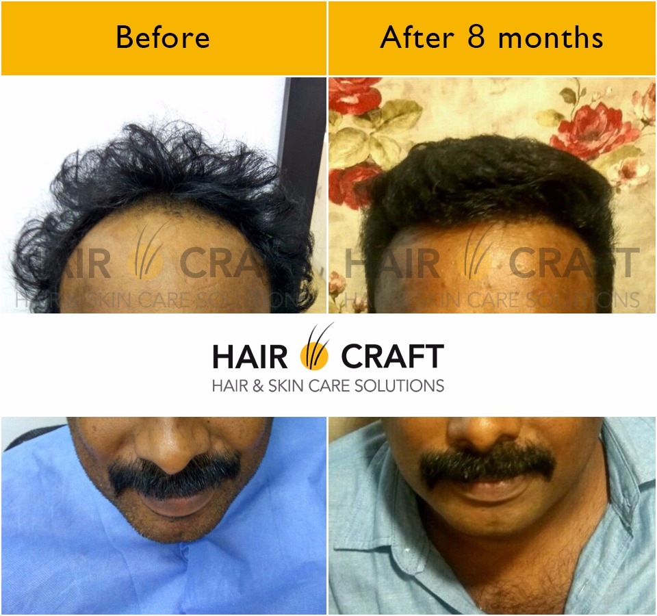 Hair O Craft in MurinjapalamThiruvananthapuram  Book Appointment Online   Best Hair Transplant Doctors in Thiruvananthapuram  Justdial