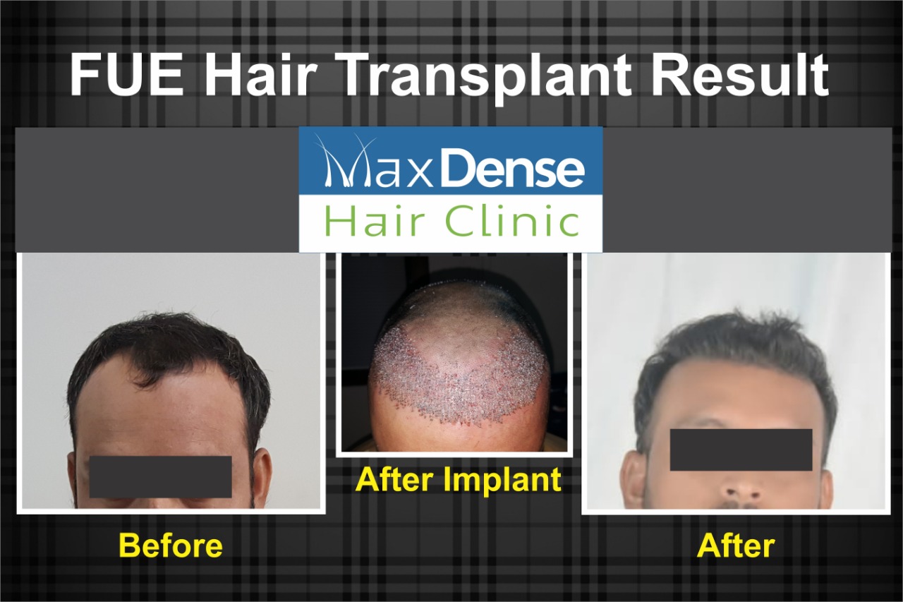 Best Hair Specialist in Nashik  Dr Sachin Yeole  Hair Transplant in  Nashik