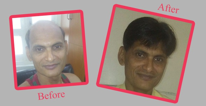 Natural Hair Fixing Center in Falnir, Mangalore-575001 | Sulekha Mangalore