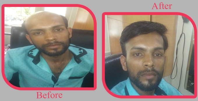 Natural Hair Fixing Center in Falnir, Mangalore-575001 | Sulekha Mangalore Natural Hair Fixing Center in Falnir, Mangalore-575001 | Sulekha Mangalore