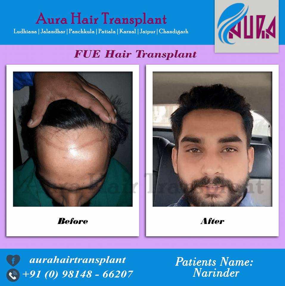 Aura Hair Transplant in Pakhowal Road, Ludhiana-141013 | Sulekha Ludhiana