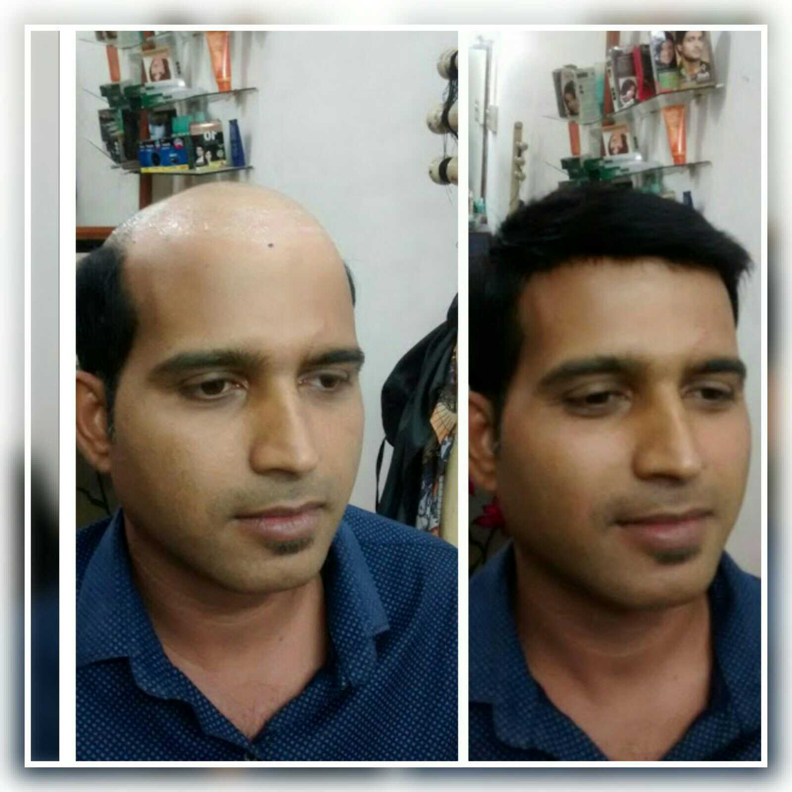 Best Hospitals for HAIR TRANSPLANT in MANGALORE Cost of HAIR TRANSPLANT in  MANGALORE
