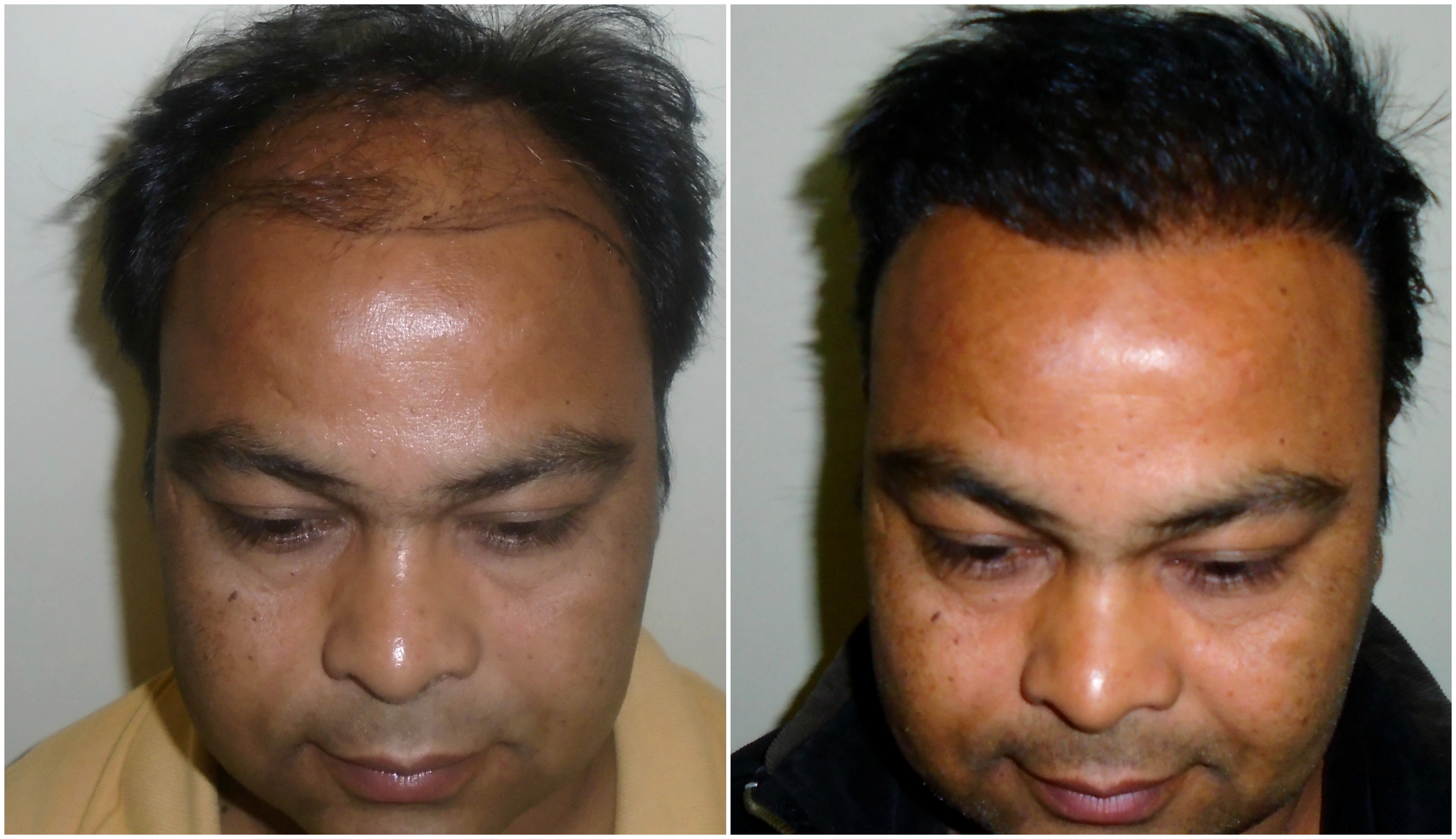 . Hair Transplant Clinic in Sector 19, Noida-201301 | Sulekha Noida . Hair Transplant Clinic in Sector 19, Noida-201301 | Sulekha Noida