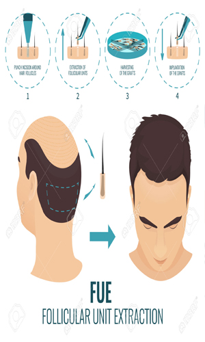 10 Best Hair Transplant Centres In Gurgaon  We Are Gurgaon