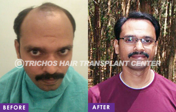 Trichos Hair Transplant Institute Pvt. Ltd. in Kapra, Hyderabad-500062 |  Sulekha Hyderabad